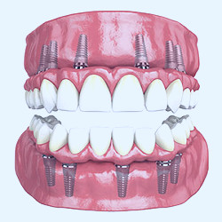 Hybridge Full Arch Dental Implant Bridge